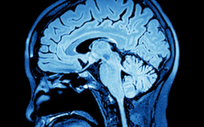 What Multiple Sclerosis Looks Like in Your Brain